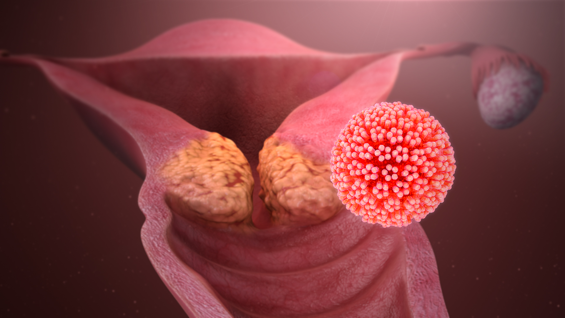 HPV GENOTYPING SCREENING FOR CERVICAL CANCER USING REALTIME PCR